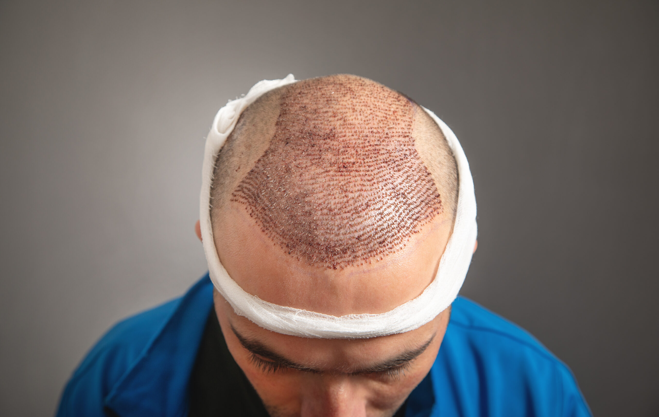 Caucasian man after hair transplantation.