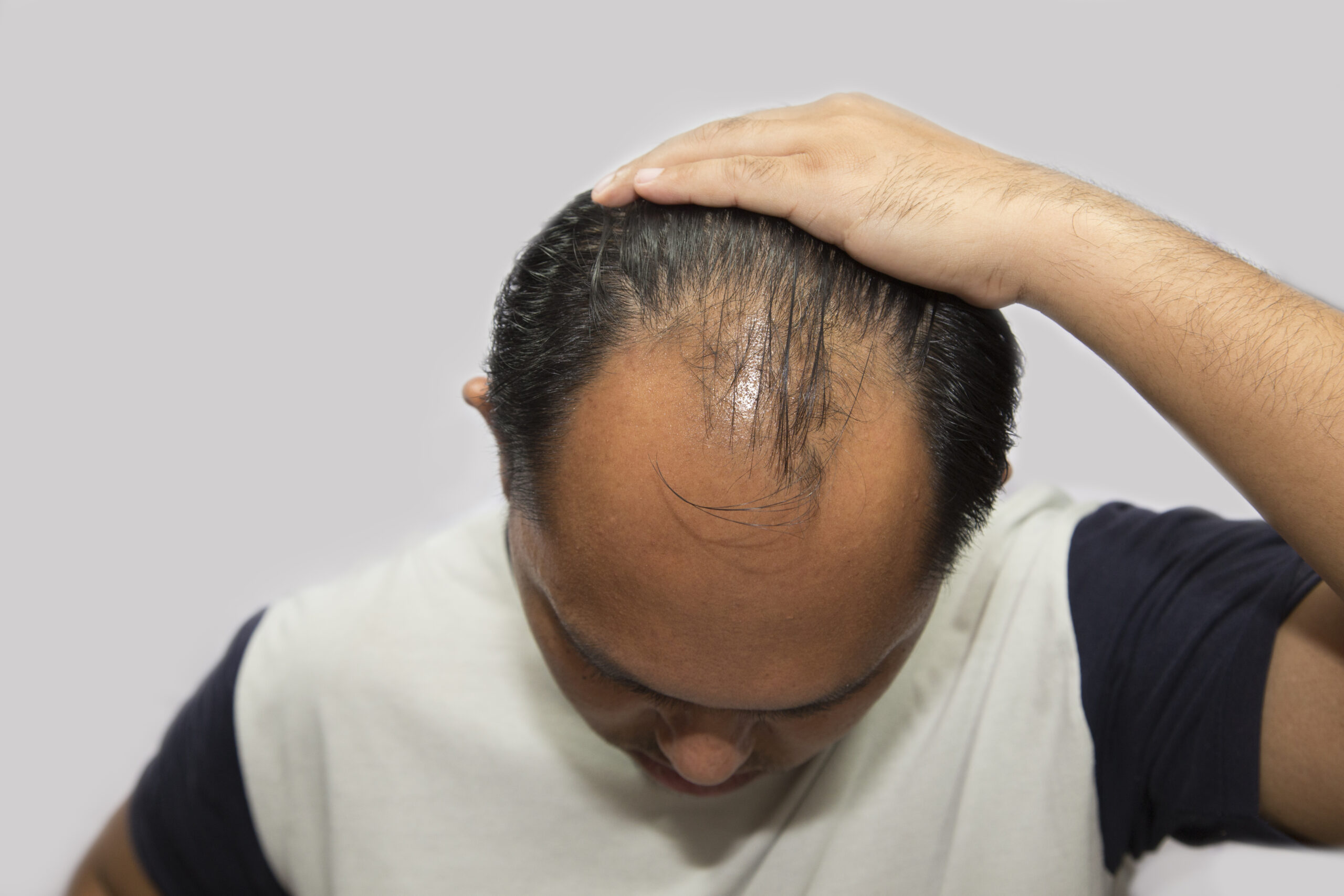close-up-serious-man-with-receding-hairline-against-white-background (1)