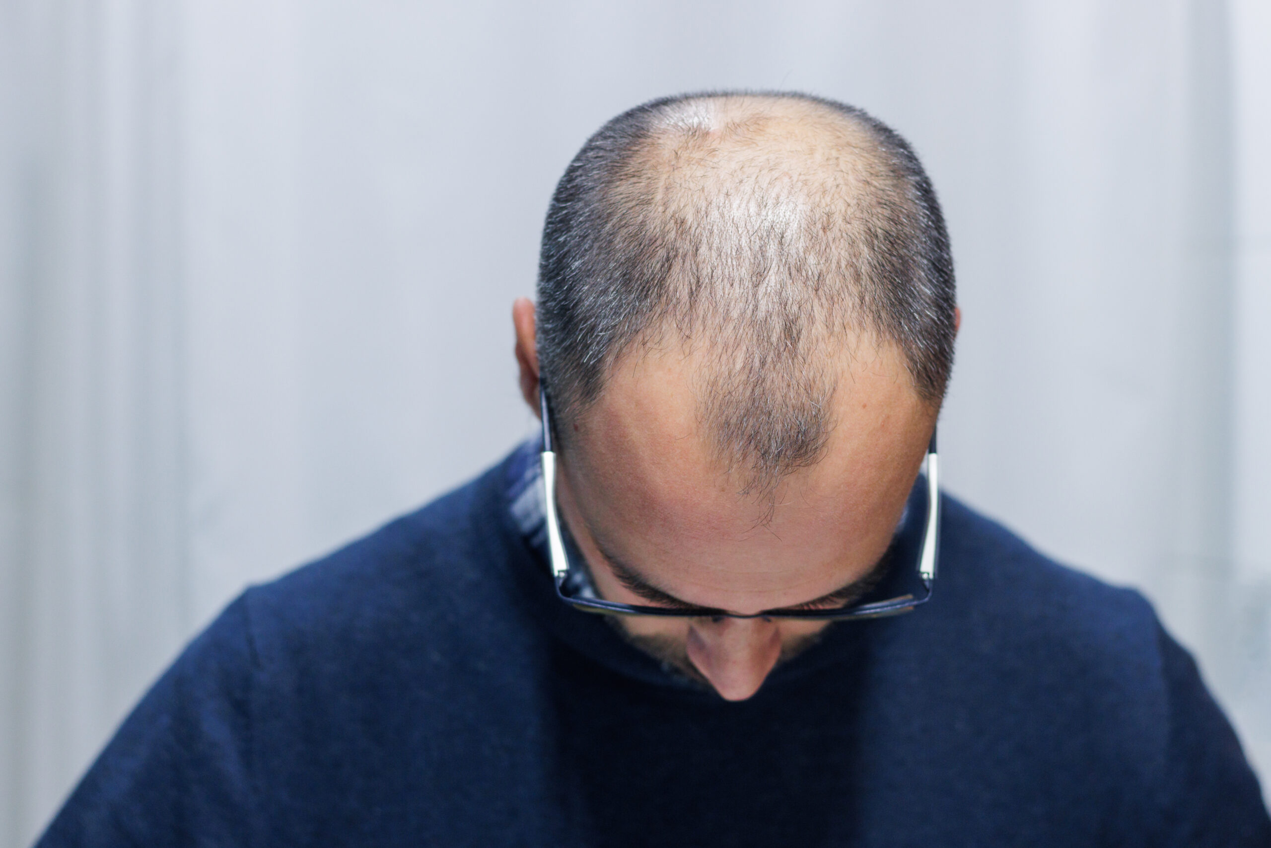 Young man with alopecia looking at his head and hair in the mirror at home